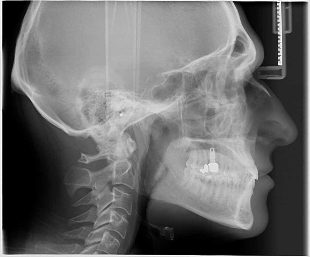 Cefalometrie laterală — teleradiografie de profil a craniului