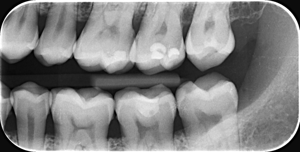 Radiografie bite-wing — coroanele dinților superiori și inferiori