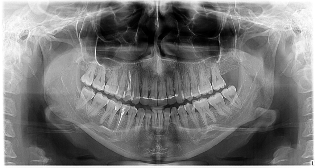 Radiografie panoramică (OPG) — ambele arcade dentare