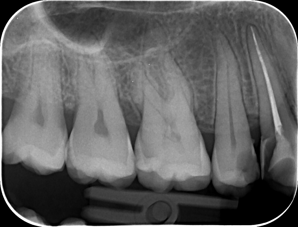 Radiografie retroalveolară — detaliu dinte și os alveolar