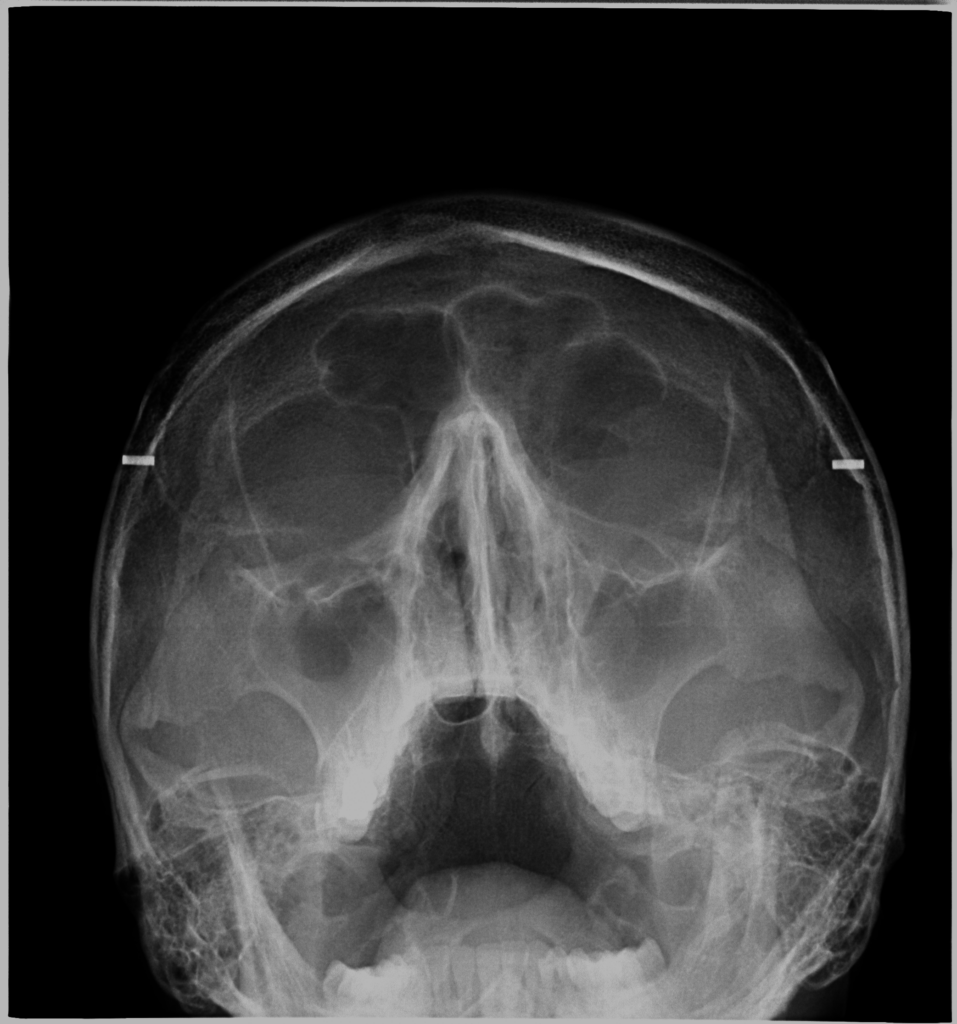 Radiografie SAF (incidență Waters) — sinusurile anterioare
