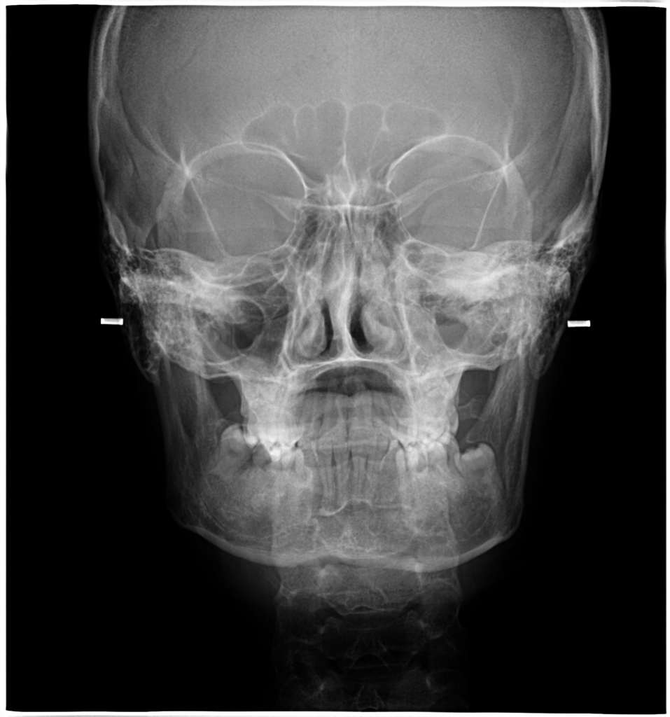 Teleradiografie craniu antero-posterior